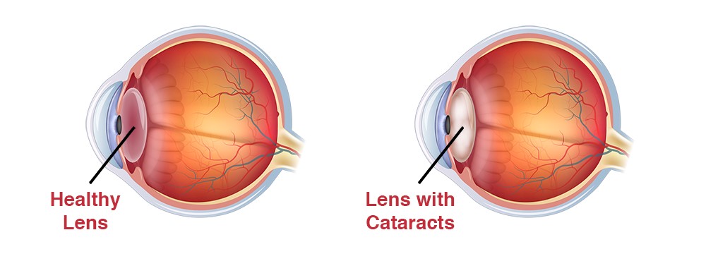 What Is a Cataract