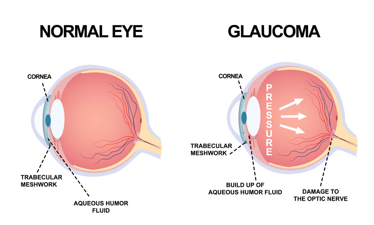 glaucoma-laser-treatment