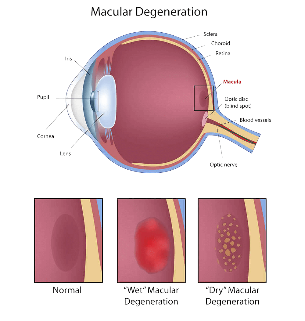 macular-degeneration-chart (1) macular-degeneration-chart (1)