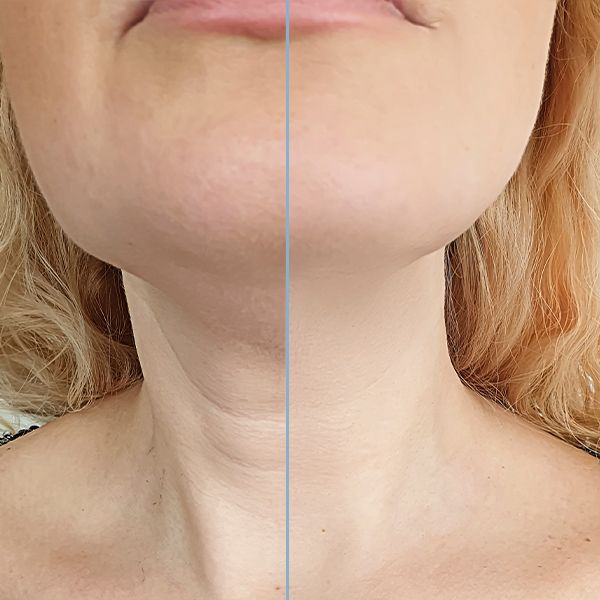 Neck Lift