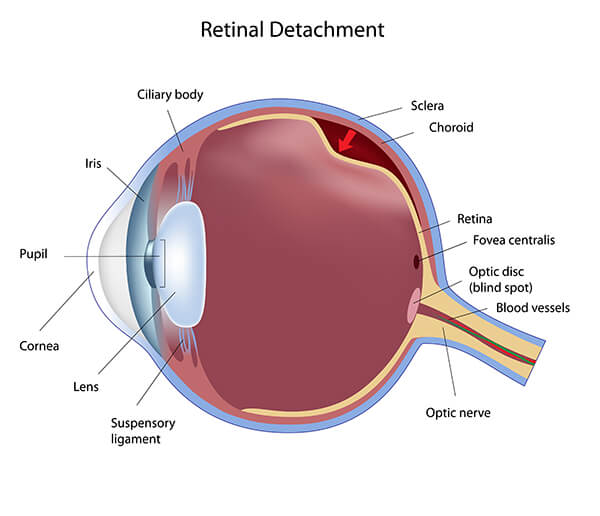 retinal-detachment