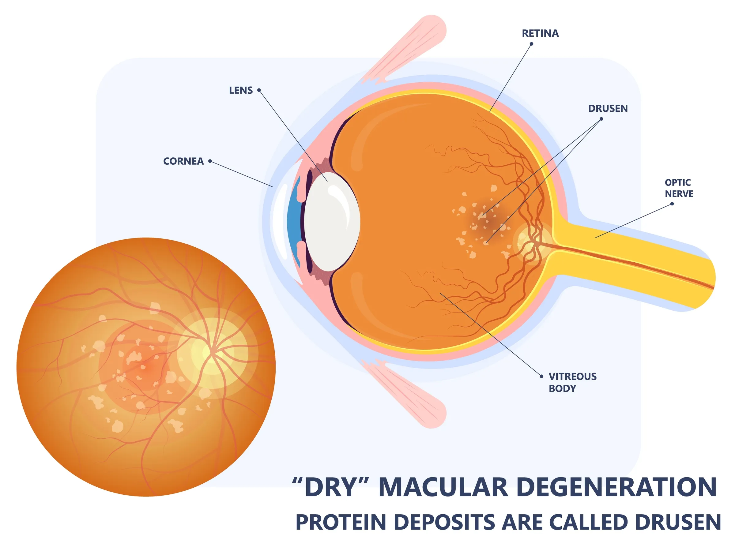 macular-degeneration-2