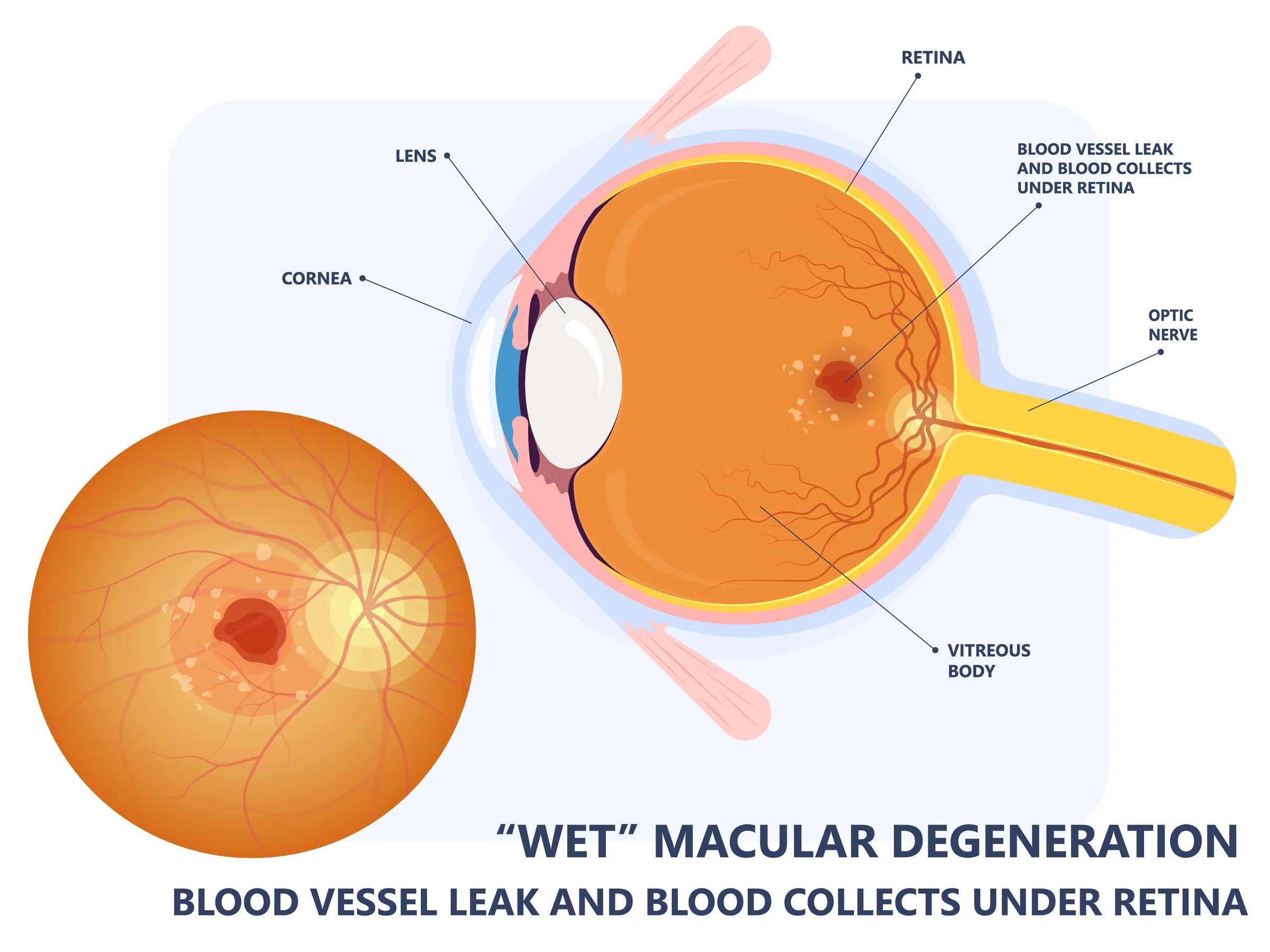 macular-degeneration-3